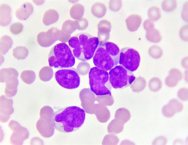 AbbVie presenta a la FDA una NDA suplementaria de venetoclax para tratar la leucemia mieloide aguda