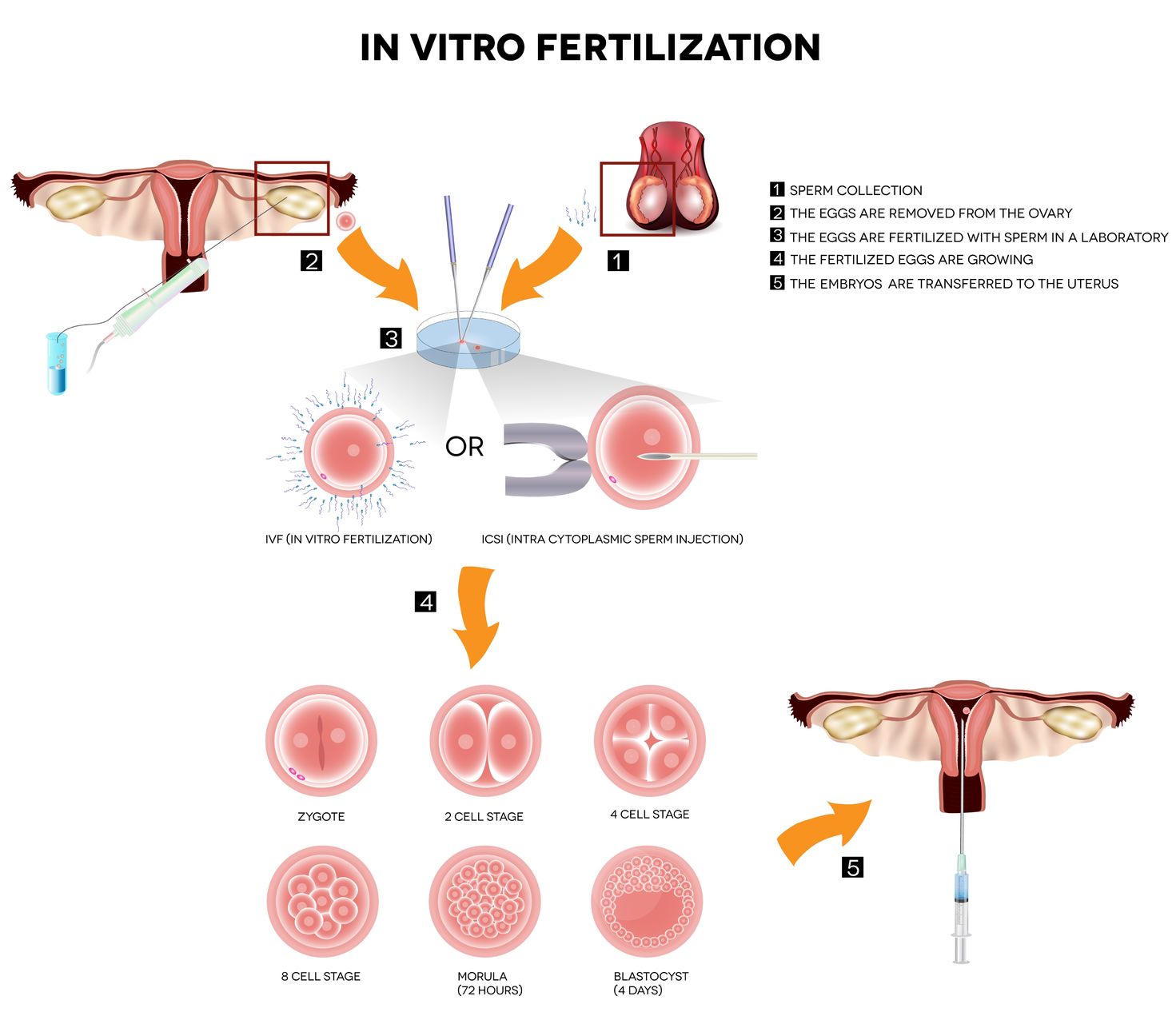 proceso fecundación in vitro