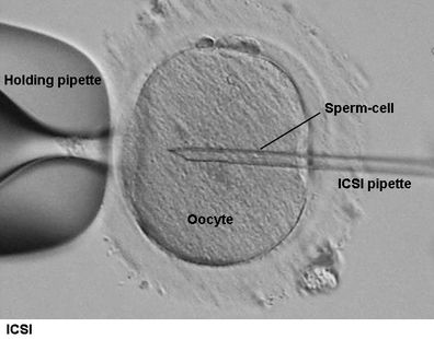 En qué consiste la FIV con ICSI