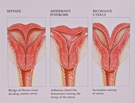 Qué son las malformaciones uterinas