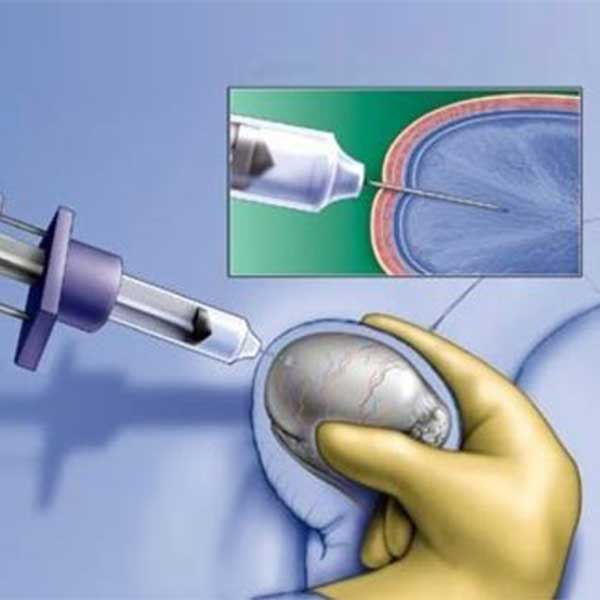 En qué consiste la biopsia testicular