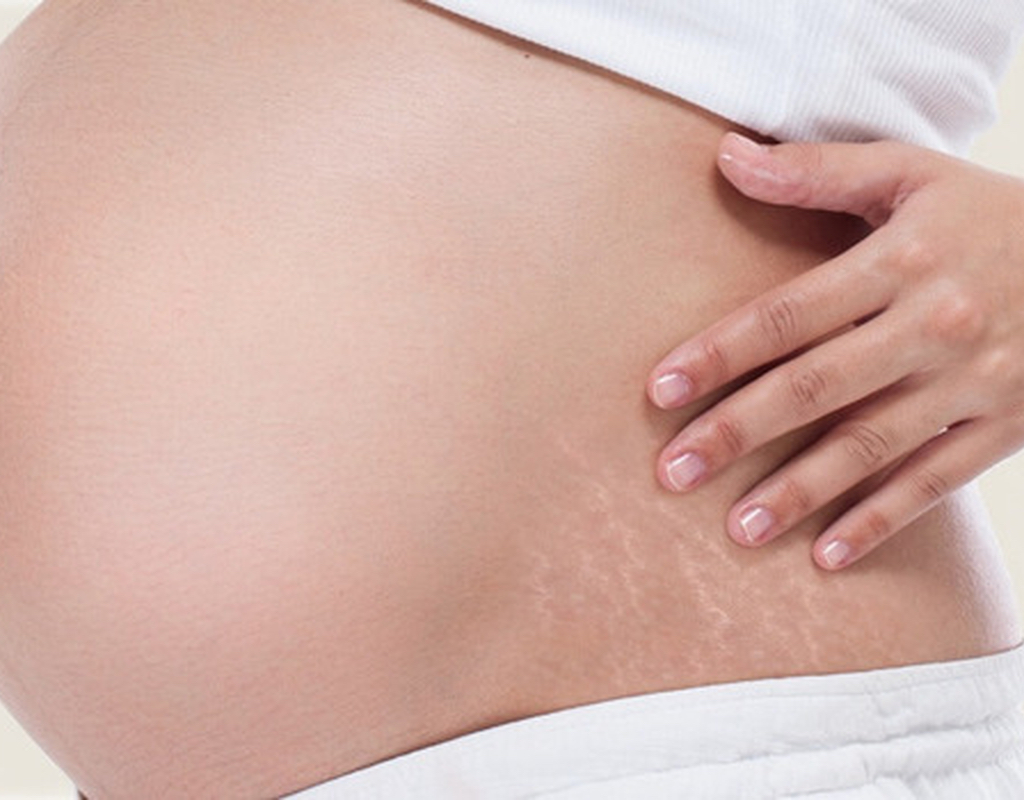 ¿Se pueden evitar las estrías tras el embarazo?