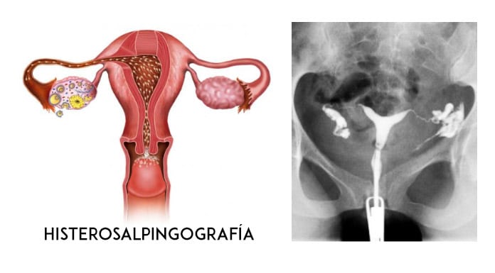 En qué consiste la Metrosalpinografía