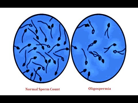 Qué es la oligospermia
