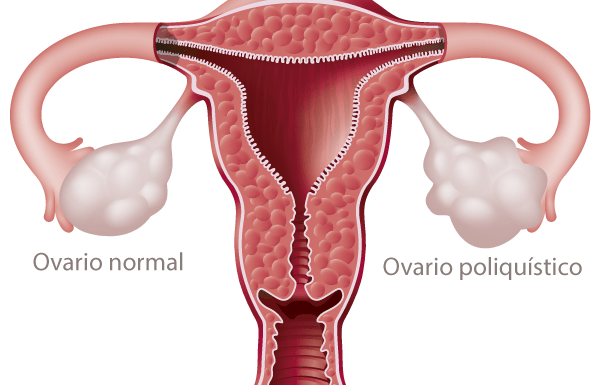 Embarazo y síndrome de ovario poliquístico