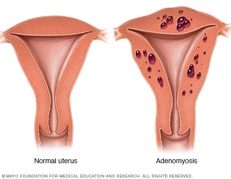 Qué es la adenomiosis