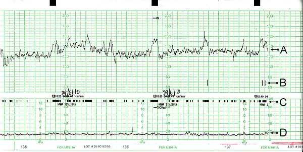 ¿Qué es la cardiotocografía?