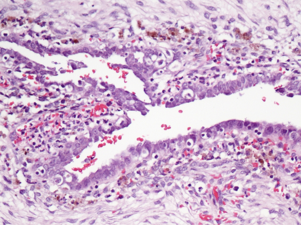 El rasgado endometrial no mejora la fertilidad