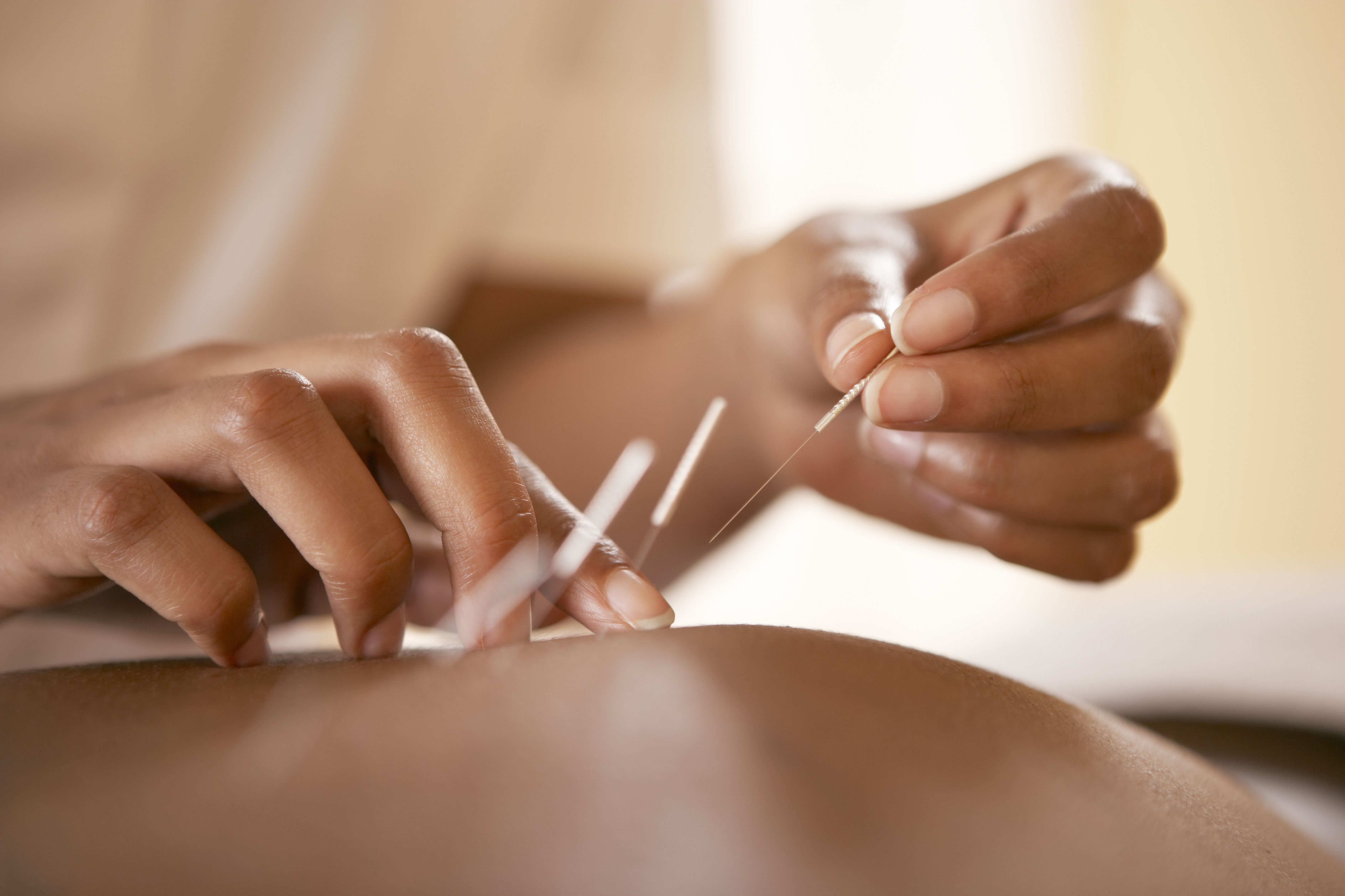 ¿Es segura la acupuntura durante el embarazo?