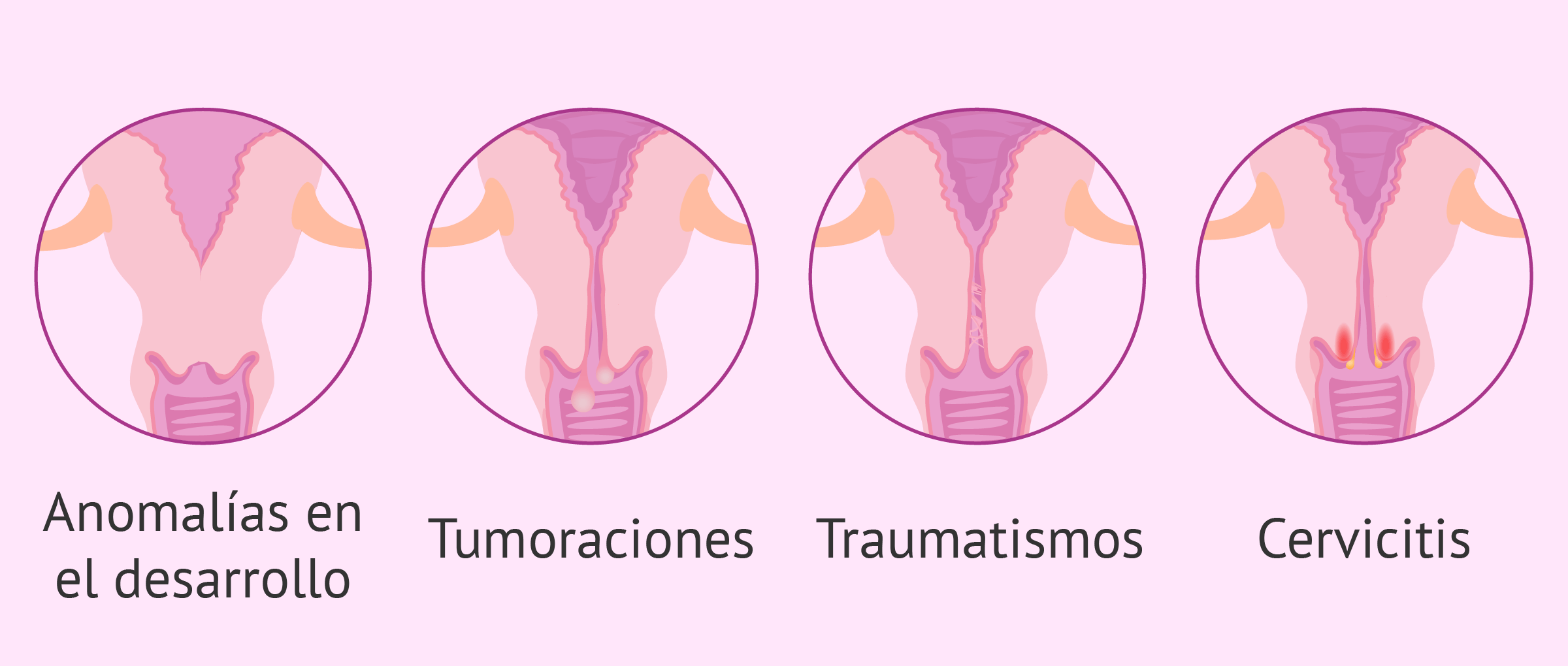 Quedarse embarazada después de una estenosis cervical