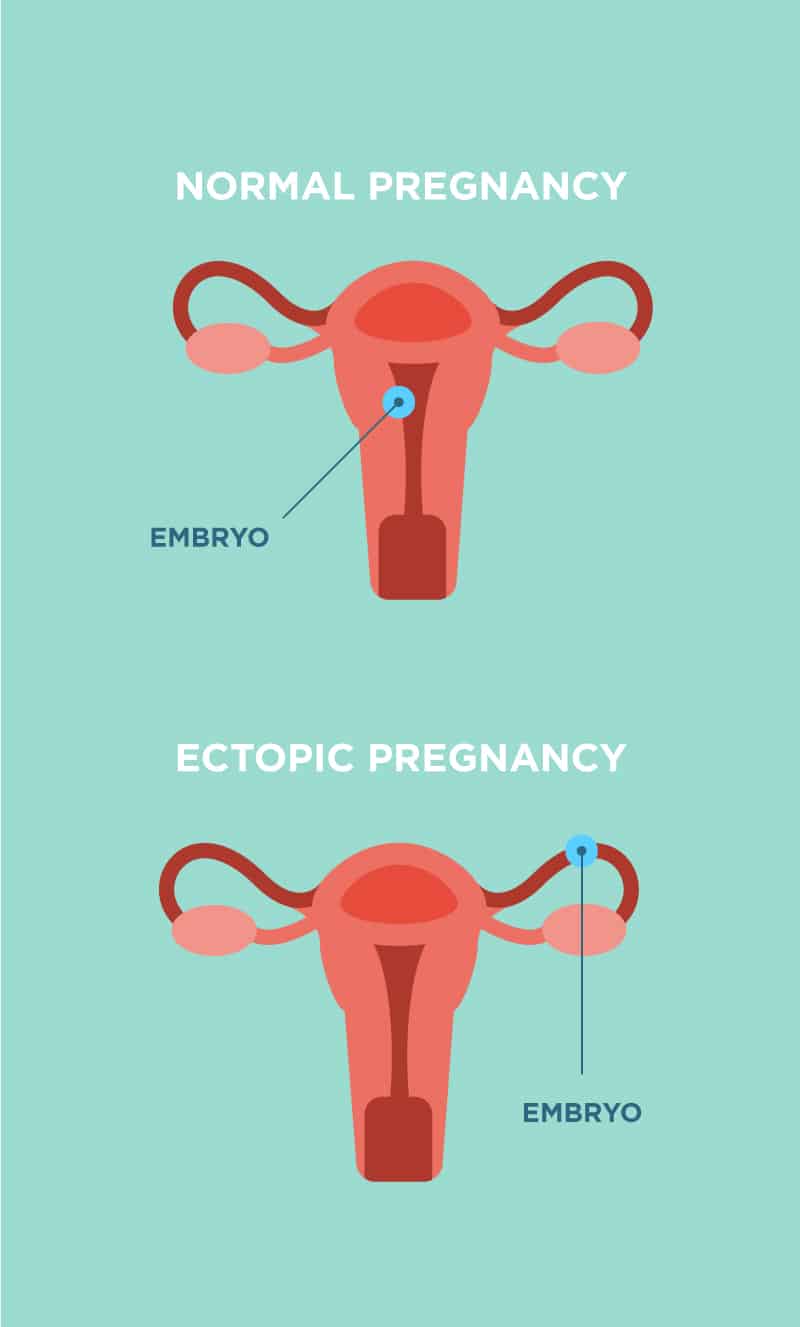 Lo que hay que saber sobre el embarazo ectópico