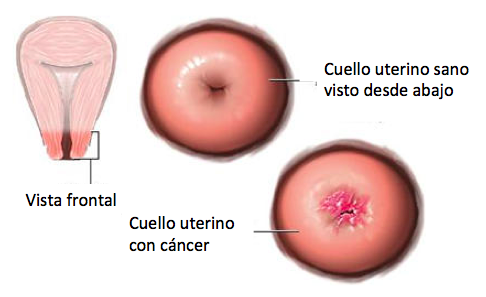 Nuevas directrices sobre el cuidado del cáncer de cuello de útero