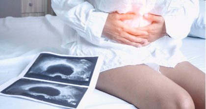 La ESHRE publica una nueva guía sobre el diagnóstico y el tratamiento de la endometriosis