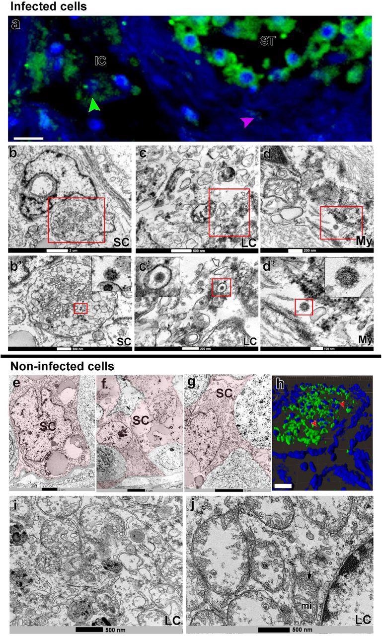 SARS-CoV-2 infection in Sertoli, Leydig and peritubular myoid cells. a) Immunofluorescence against S-protein evidencing weak labeling in peritubular myoid (pink arrowhead) and Leydig cells (green arrowhead) (Scale bar =15µm). b-d’) TEM images showing viral particles (in low and high magnification) in Sertoli cell (SC) (Scale bars = b: 2µm; b’: 500nm); Leydig cell (LC) (Scale bars = c: 500nm; c’: 200nm and peritubular myoid cell (My) (Scale bars = d: 200nm; d’: 100nm). e-g) TEM images of non-infected Sertoli cells (SC, pink) (Scale bars = e: 2µm f-g: 5µ). h) 3D reconstruction of a seminiferous tubule cross-section showing non-labeled areas surrounding germ cells (red arrowheads) (Scale bar = 40µm). i-j) high magnification of non-infected Leydig cells. Arrow = tubular crest of a mitochondria (mi) (Scale bars = 500nm). Immunofluorescence images in the testis of patient #8. TEM images in testes from patients #1, #7 and #8.