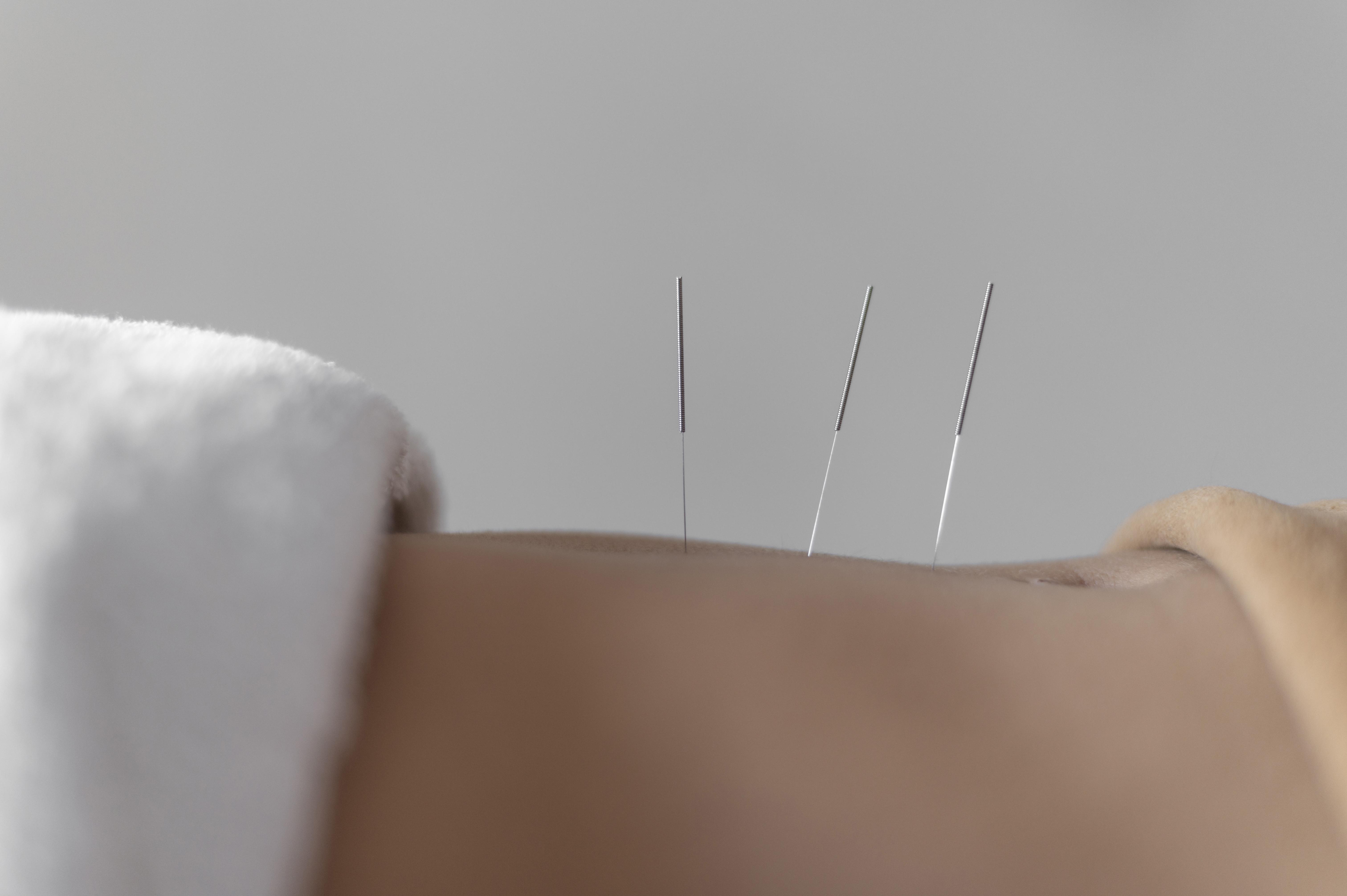 ¿Funciona realmente la acupuntura para la fertilidad?