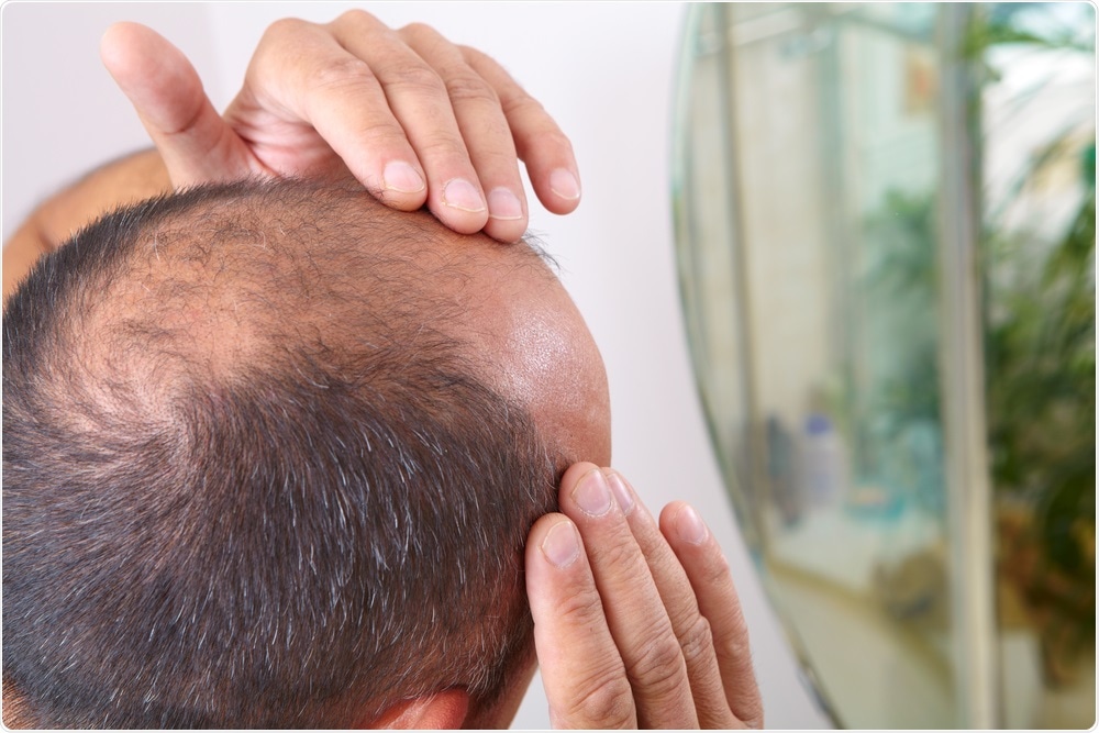 Man with bald patch