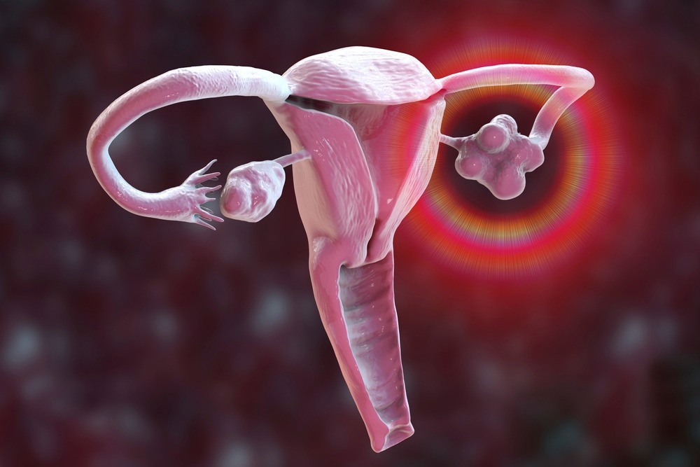 Study: Diagnosis and management of polycystic ovarian syndrome. Image Credit: Kateryna Kon/Shutterstock.com Study: Diagnosis and management of polycystic ovarian syndrome. Image Credit: Kateryna Kon/Shutterstock.com