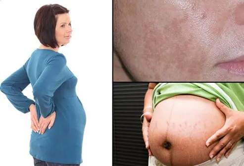 Una mujer embarazada con dolor de espalda (izquierda), mujer embarazada con estrías y línea que corre por su abdomen (centro) y mujer con melasma (máscara del embarazo) en su mejilla (derecha).